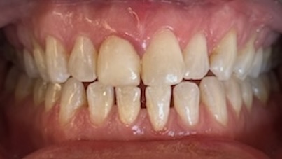 Cosmetic closeup before-case4a_before